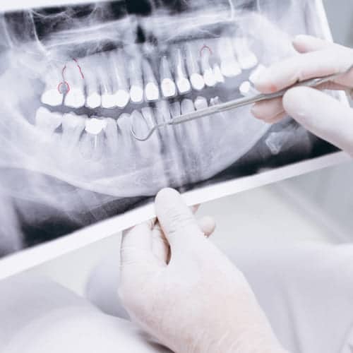 Prótesis sobre implantes en Gijón